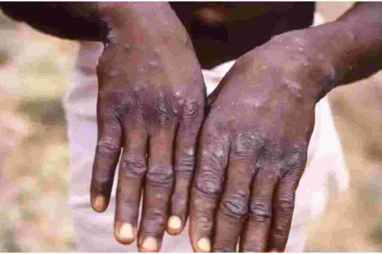 Health Ministry Says No Case of Monkeypox Recorded in Kenya