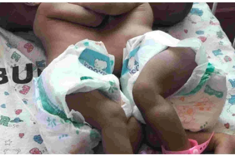 Kenyan Woman Appeals for Help After Giving Birth to Conjoined Twins