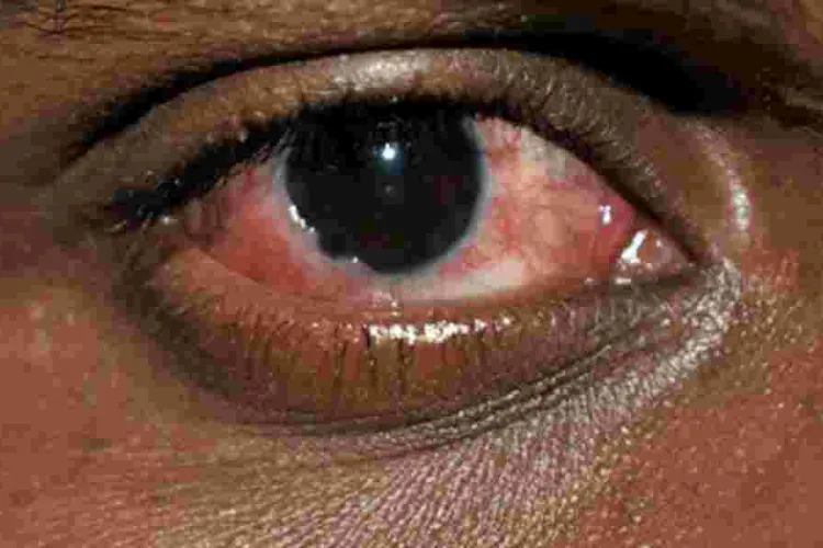 The Surge of Red Eye Disease in Kenya's Coast Region