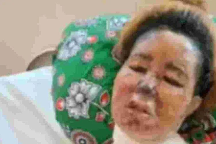 Mombasa Woman Fights for Her Life After Boyfriend Scalds Her Face with Boiling Oil 