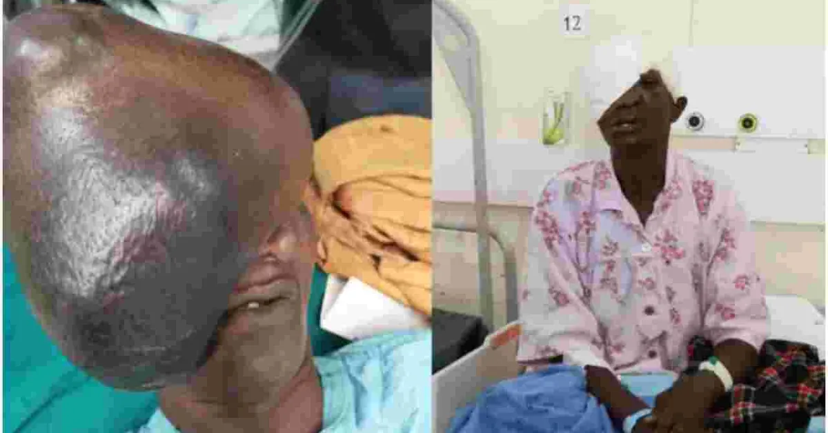Kenyan Doctors Remove 3kg Growth on Elderly Woman's Face, Ending 21 Years of Agony