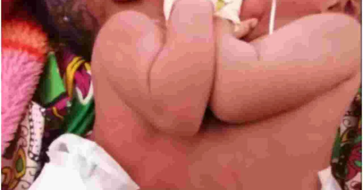Kenyan Teenager Gives Birth to Conjoined Twins at Lenmek Hospital
