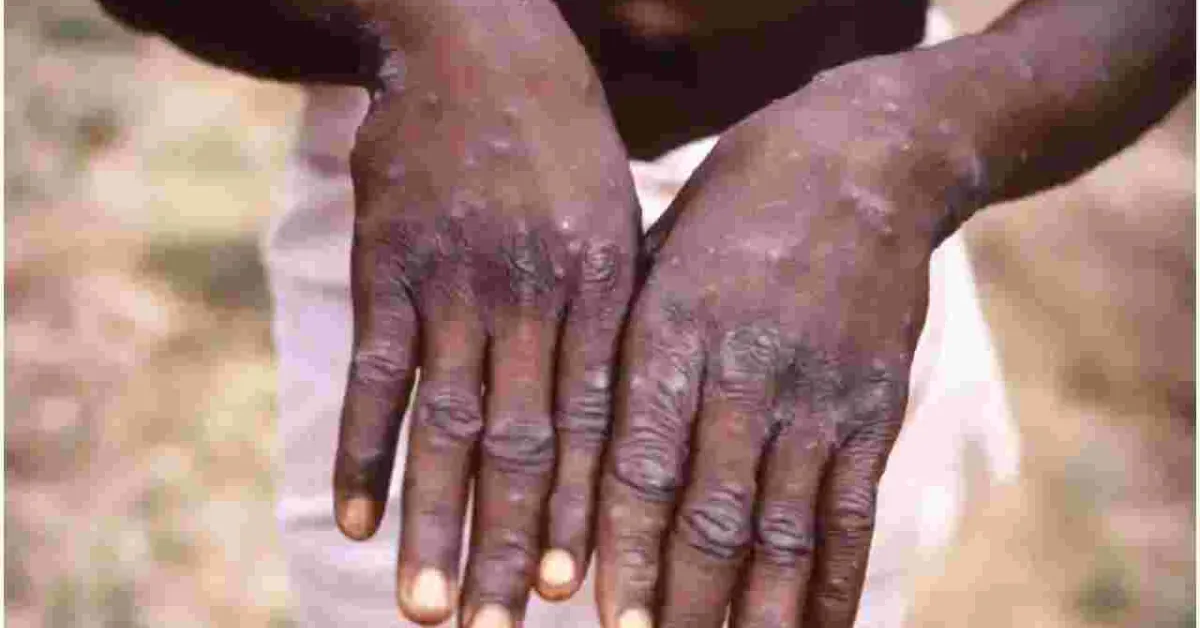 Health Ministry Says No Case of Monkeypox Recorded in Kenya