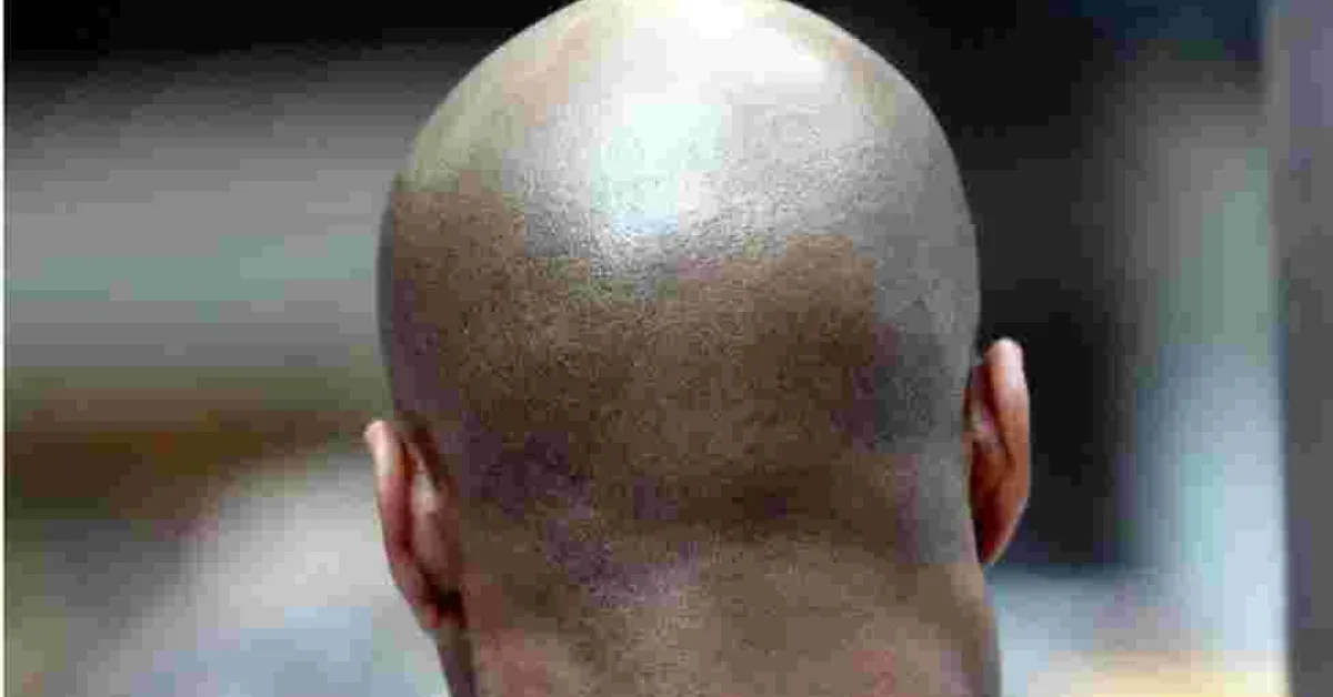British Court Rules Calling a Man 'Bald' is Sexual Harassment