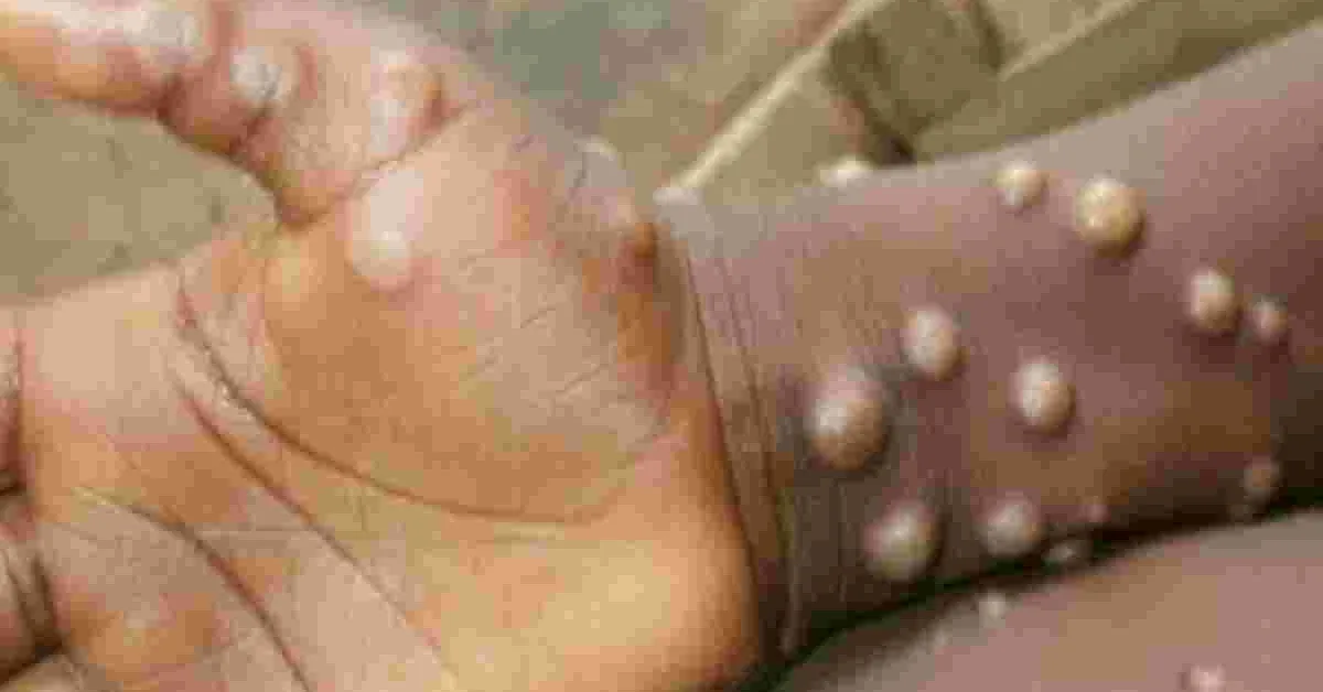 US Pharmaceutical Company Tonix to Conduct Monkeypox Vaccine Trials in Kenya