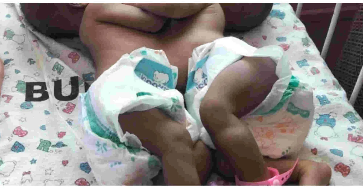 Kenyan Woman Appeals for Help After Giving Birth to Conjoined Twins
