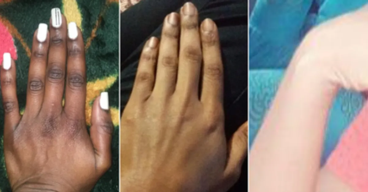 Kenya Battles Skin Bleaching Trend Despite Ban on 400 Dangerous Cosmetics