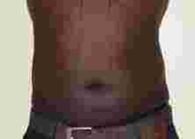 Number of Kenyan Men Seeking Belly Fat Removal Grow