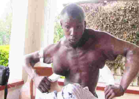 Kenyan Man with Abnormal Swelling in Chest, Arms Seeks Help to Get Live-Saving Surgery  
