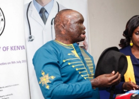 After 7 Years, Kenyan Acid Attack Survivor to Get Special Surgery in the US