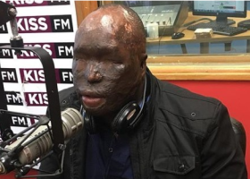 Kenyan Man Attacked with Acid by Wife Arrives in US for Specialized Surgery