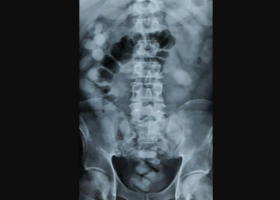 Thailand: Kenyan Woman Busted Carrying 1.2 Kilos of Cocaine in Her Stomach