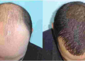 Hair Transplant Clinic Opened in Nairobi
