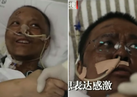 Chinese Doctors' Skin Color Turn Black after Recovering from Covid-19