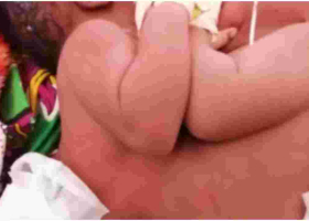 Kenyan Teenager Gives Birth to Conjoined Twins at Lenmek Hospital