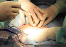Catholic Priest Undergoes First Successful Heart Valve Transplant in Kenya