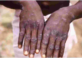 Health Ministry Says No Case of Monkeypox Recorded in Kenya