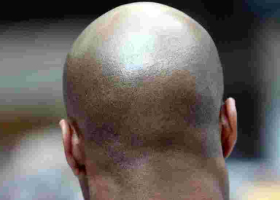  British Court Rules Calling a Man 'Bald' is Sexual Harassment