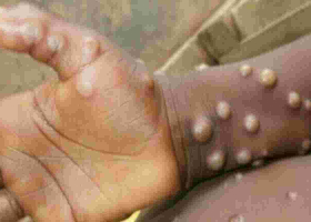 US Pharmaceutical Company Tonix to Conduct Monkeypox Vaccine Trials in Kenya 