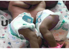 Kenyan Woman Appeals for Help After Giving Birth to Conjoined Twins