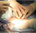 Catholic Priest Undergoes First Successful Heart Valve Transplant in Kenya