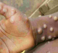 US Pharmaceutical Company Tonix to Conduct Monkeypox Vaccine Trials in Kenya 
