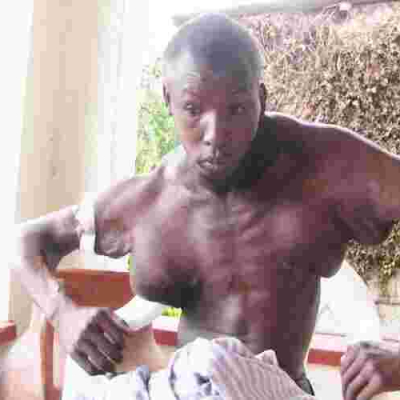 Kenyan Man with Abnormal Swelling in Chest, Arms Seeks Help to Get Live-Saving Surgery  