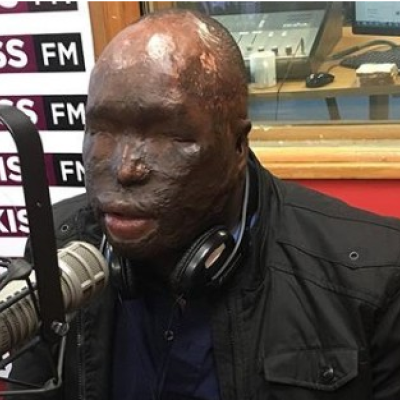 Kenyan Man Attacked with Acid by Wife Arrives in US for Specialized Surgery