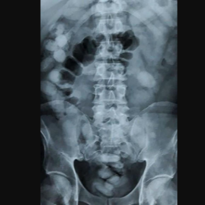 Thailand: Kenyan Woman Busted Carrying 1.2 Kilos of Cocaine in Her Stomach