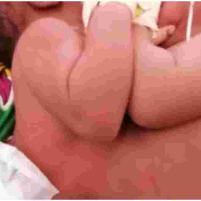 Kenyan Teenager Gives Birth to Conjoined Twins at Lenmek Hospital