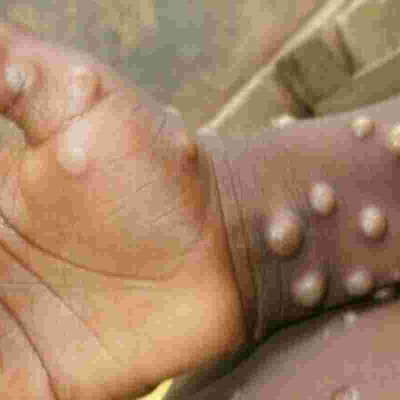 US Pharmaceutical Company Tonix to Conduct Monkeypox Vaccine Trials in Kenya 