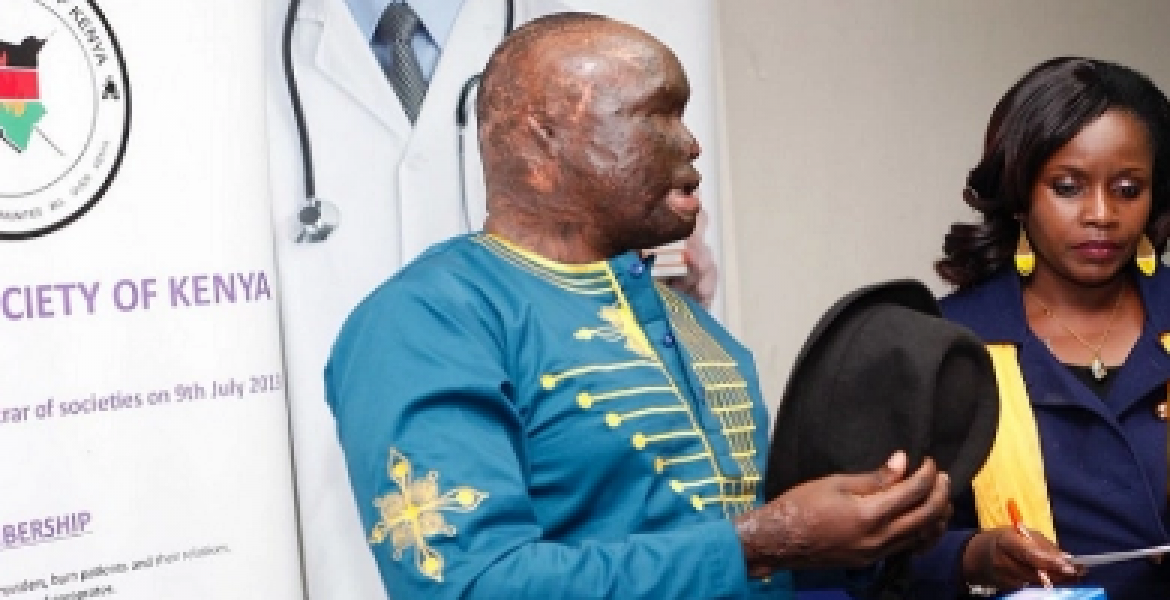 After 7 Years, Kenyan Acid Attack Survivor to Get Special Surgery in the US