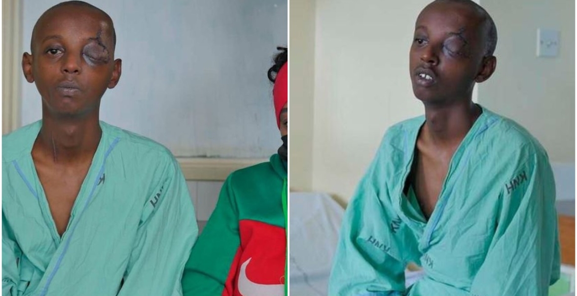 Knh Surgeons Save Teen With A Knife Lodged In The Eye