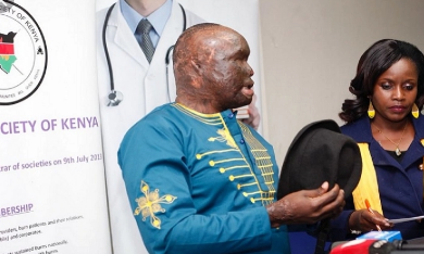 After 7 Years, Kenyan Acid Attack Survivor to Get Special Surgery in the US