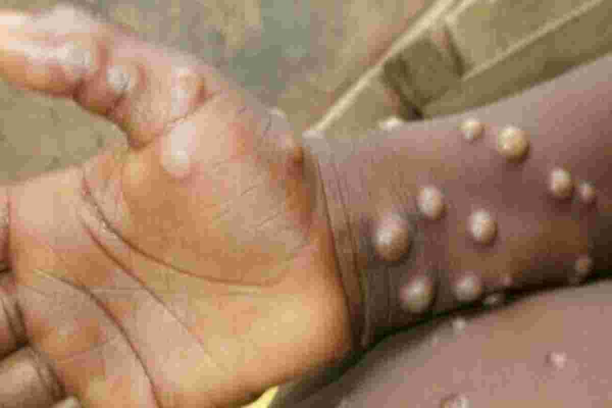 US Pharmaceutical Company Tonix to Conduct Monkeypox Vaccine Trials in Kenya