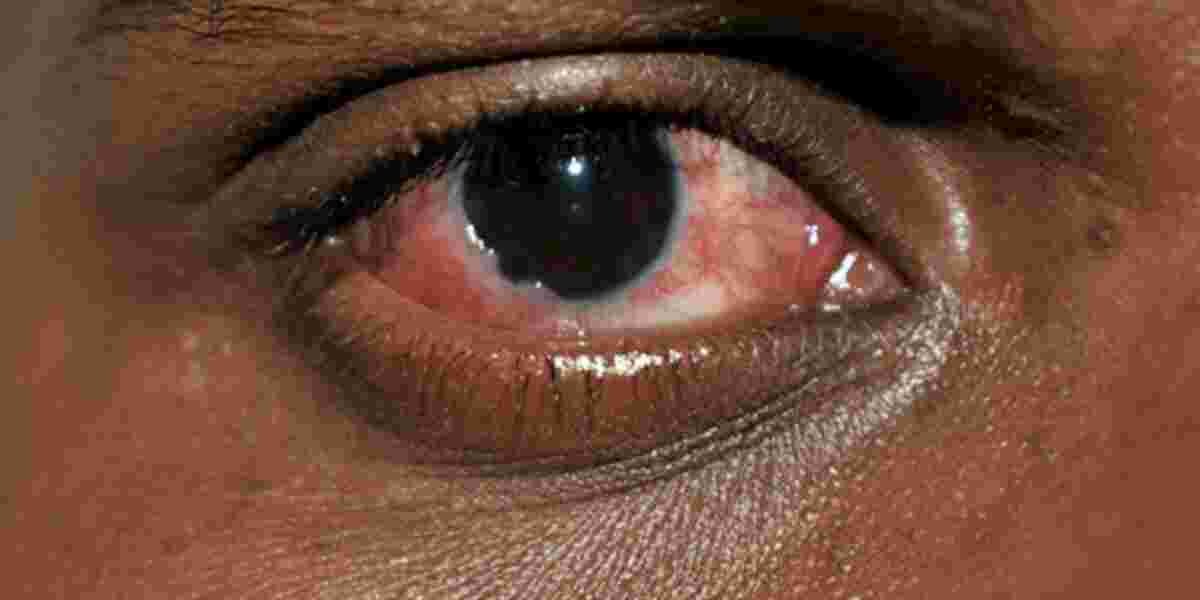 The Surge of Red Eye Disease in Kenya's Coast Region