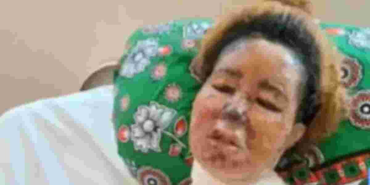 Mombasa Woman Fights for Her Life After Boyfriend Scalds Her Face with Boiling Oil