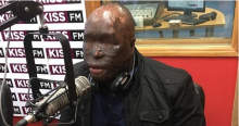 Kenyan Man Attacked with Acid by Wife Arrives in US for Specialized Surgery