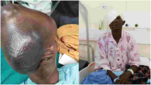 Kenyan Doctors Remove 3kg Growth on Elderly Woman's Face, Ending 21 Years of Agony  