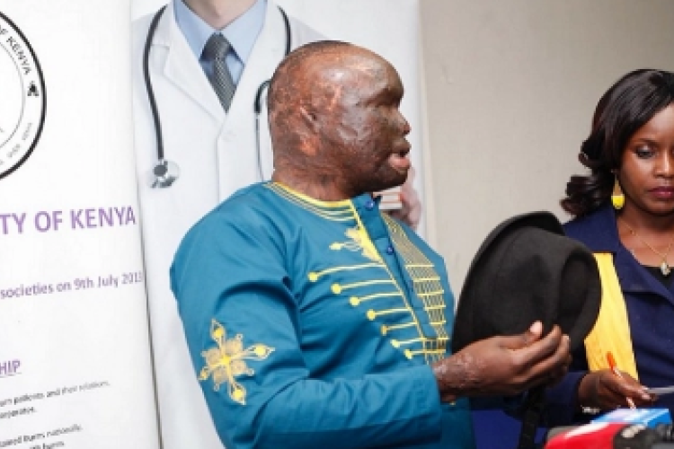 After 7 Years, Kenyan Acid Attack Survivor to Get Special Surgery in the US