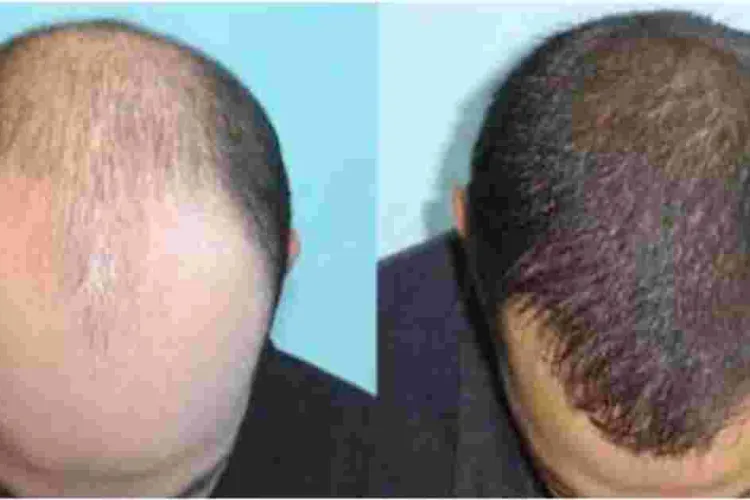 Hair Transplant Clinic Opened in Nairobi