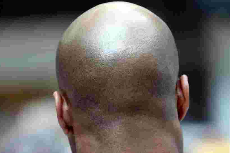  British Court Rules Calling a Man 'Bald' is Sexual Harassment