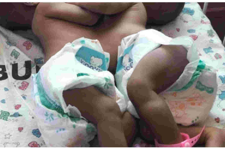 Kenyan Woman Appeals for Help After Giving Birth to Conjoined Twins